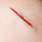Significado de los sue�os so�ar con una herida