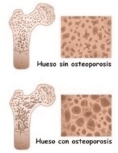 ¿A qué se debe que se eleve la probabilidad de sufrir osteoporosis?